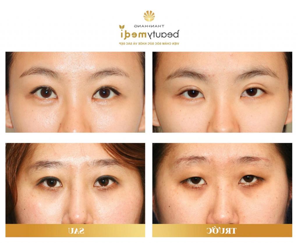 Hình ảnh khách hàng sử dụng dịch vụ phẫu thuật thẩm mỹ mắt tại Thanh Hằng Beauty Medi