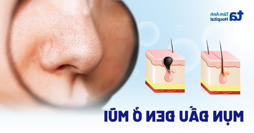 Mụn đầu đen ở mũi: Nguyên nhân, dấu hiệu, phòng ngừa