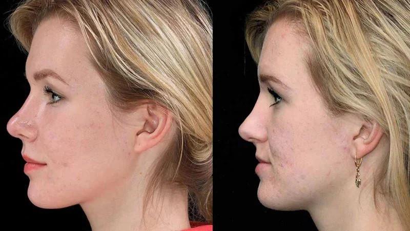 Những đối tượng có khớp cắn sâu hoặc hở nên thực hiện bài tập mewing để cải thiện khuôn mặt cân đối hơn