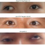Bệnh lé (bệnh lác) mắt nguyên nhân và cách điều trị