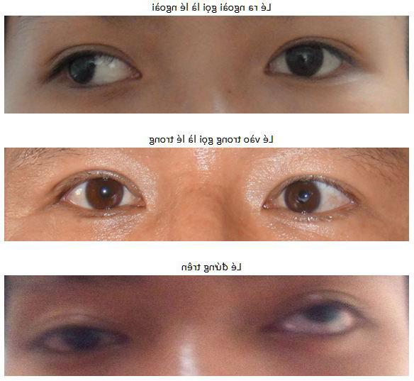 Bệnh lé (bệnh lác) mắt nguyên nhân và cách điều trị