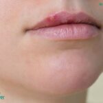 Mọc mụn ở viền môi: Nguyên nhân và cách điều trị