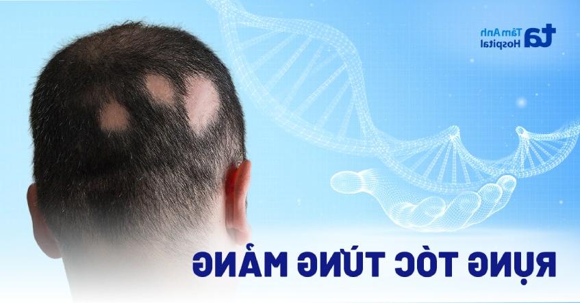 Rụng tóc từng mảng: Nguyên nhân, triệu chứng, chẩn đoán, điều trị